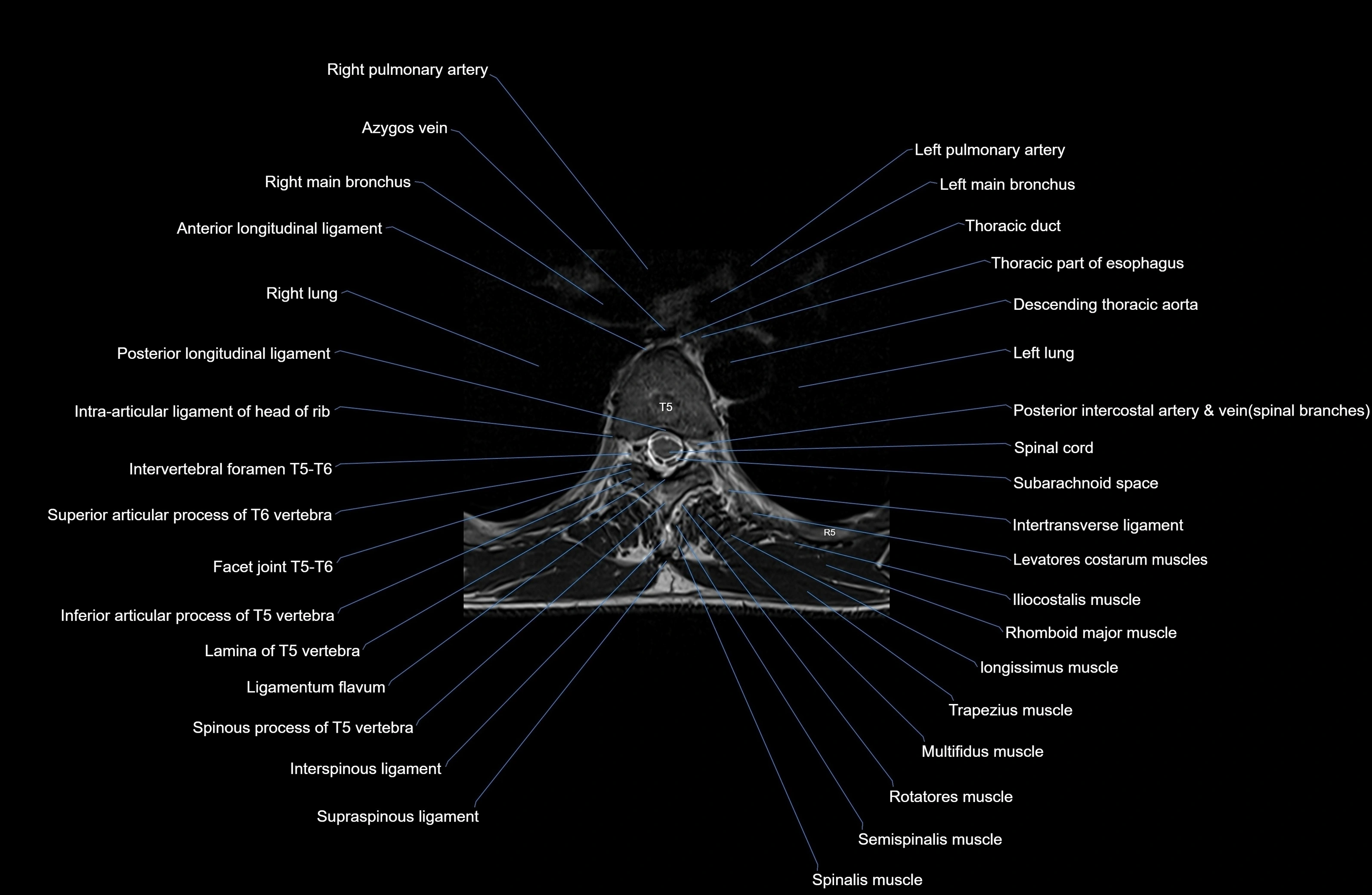 MRI thoracic spine axial  cross sectional anatomy 3T radiology  image-img-00001-00034.webp